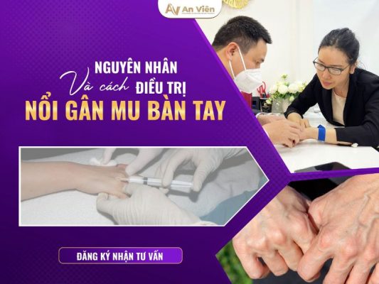 cách điều trị nổi gân mu bàn tay