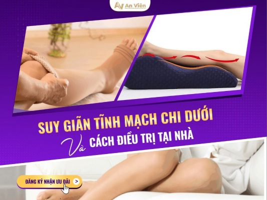 suy giãn tĩnh mạch chi dưới và cách điều trị