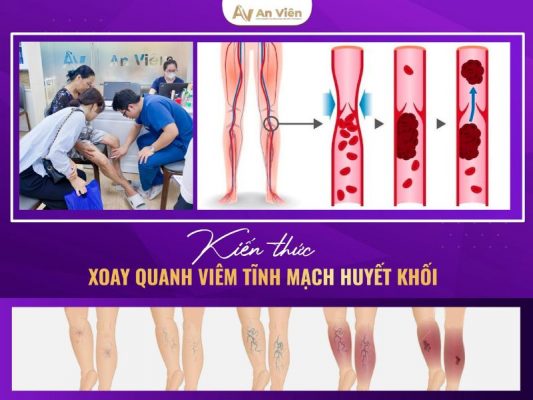 viêm tĩnh mạch huyết khối