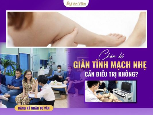 chân bị giãn tĩnh mạch nhẹ