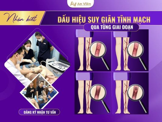 dấu hiệu giãn tĩnh mạch