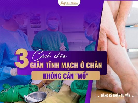 cách chữa giãn tĩnh mạch ở chân