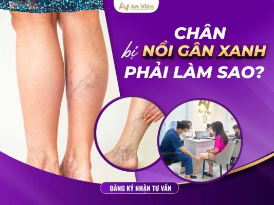chân bị nổi gân xanh phải làm sao