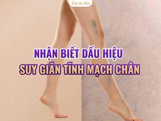 giãn tĩnh mạch chân triệu chứng