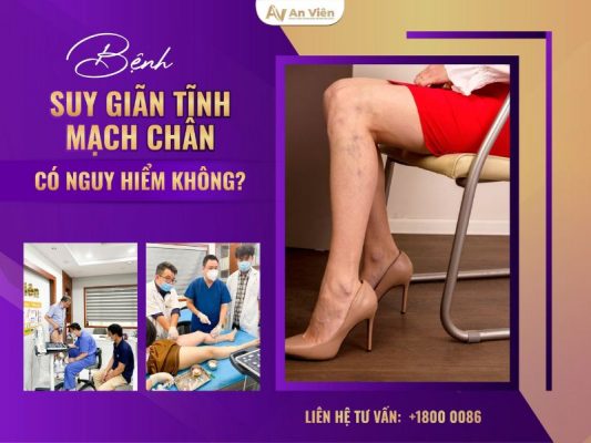 bệnh giãn tĩnh mạch chân có nguy hiểm không