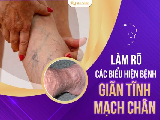 biểu hiện bệnh giãn tĩnh mạch chân