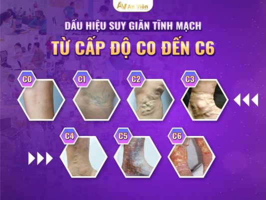 dấu hiệu của bệnh giãn tĩnh mạch