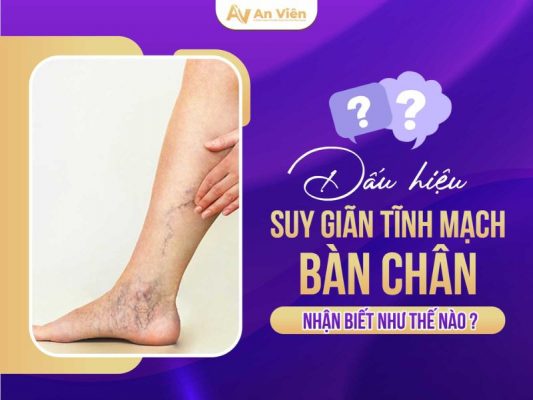 dấu hiệu giãn tĩnh mạch bàn chân