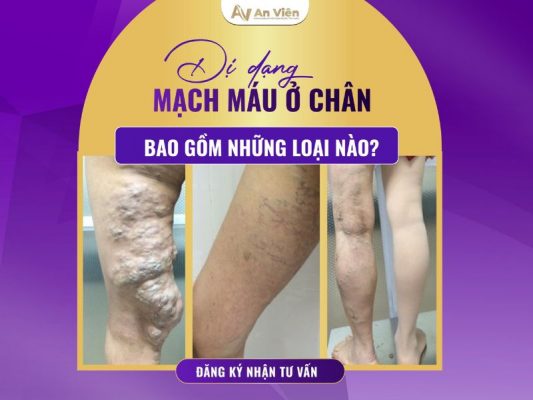 dị dạng mạch máu ở chân