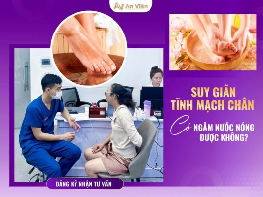 giãn tĩnh mạch chân có ngâm nước nóng được không