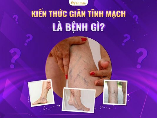 giãn tĩnh mạch là bệnh gì