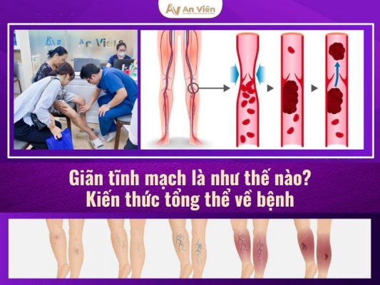 giãn tĩnh mạch là như thế nào