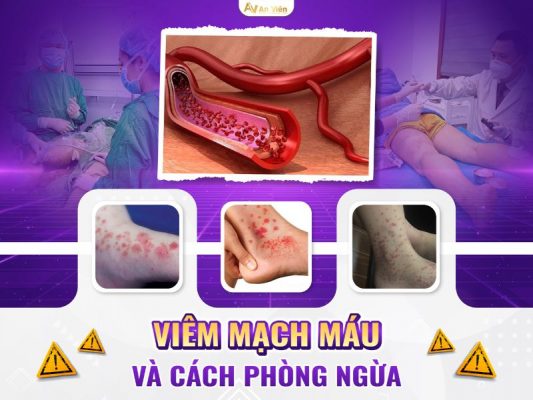 viêm mạch máu ở chân