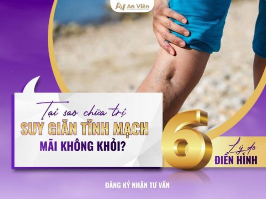 chữa trị suy giãn tĩnh mạch