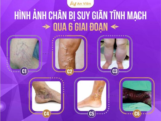 hình ảnh chân bị giãn tĩnh mạch