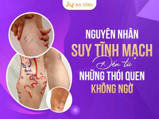 nguyên nhân suy tĩnh mạch