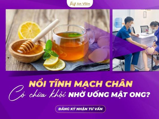 nổi tĩnh mạch chân