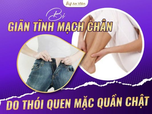 bị tĩnh mạch chân