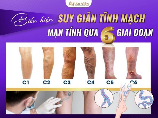 biểu hiện suy giãn tĩnh mạch
