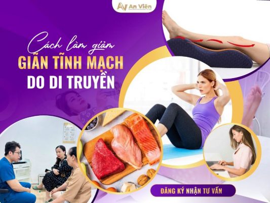 cách làm giảm suy giãn tĩnh mạch