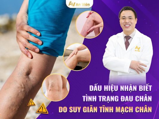 đau giãn tĩnh mạch chân