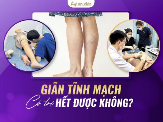 giãn tĩnh mạch có trị hết không