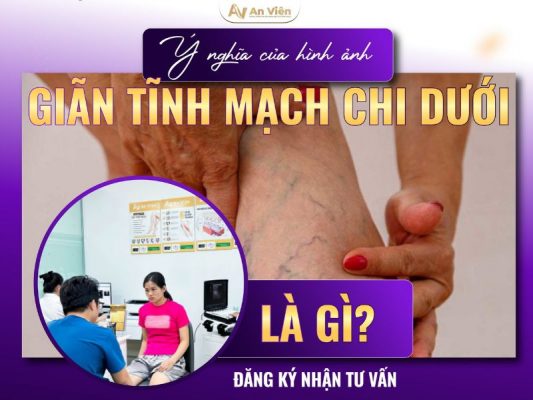 hình ảnh giãn tĩnh mạch chi dưới
