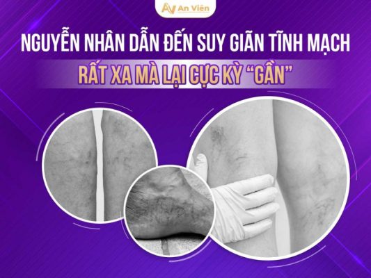 nguyên nhân dẫn đến giãn tĩnh mạch