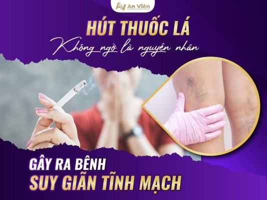 nguyên nhân gây ra bệnh giãn tĩnh mạch