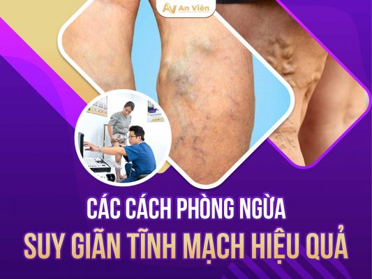 cách phòng ngừa suy giãn tĩnh mạch
