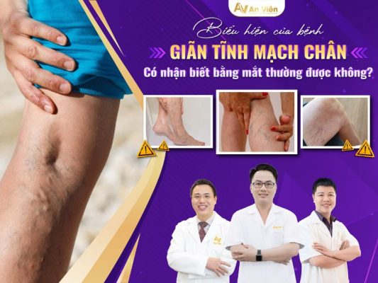 biểu hiện của bệnh giãn tĩnh mạch chân