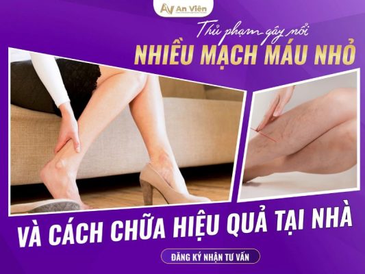 chân nổi nhiều mạch máu nhỏ