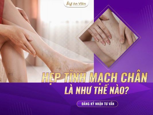 hẹp tĩnh mạch chân