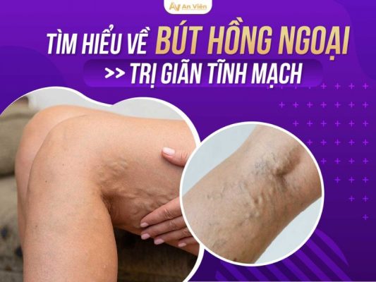 bút hồng ngoại trị giãn tĩnh mạch