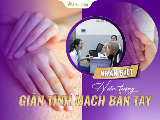giãn tĩnh mạch bàn tay