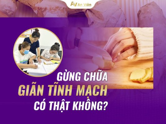 gừng chữa giãn tĩnh mạch