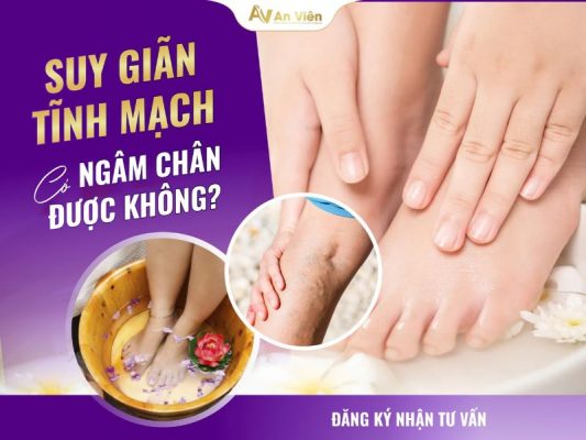 suy giãn tĩnh mạch có ngâm chân được không