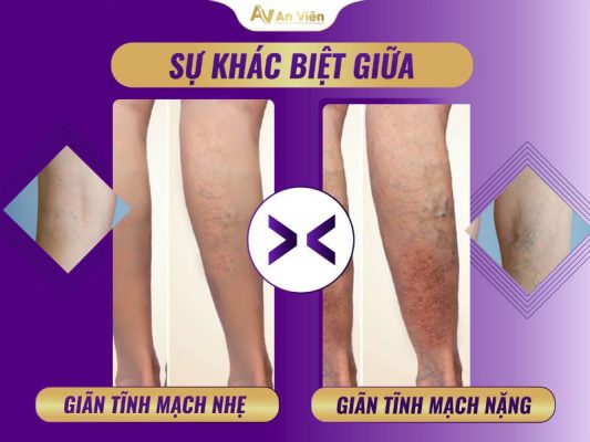 dấu hiệu giãn tĩnh mạch