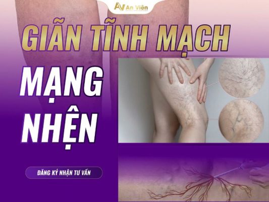 giãn tĩnh mạch mạng nhện