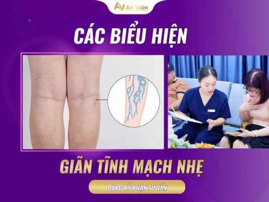 giãn tĩnh mạch nhẹ