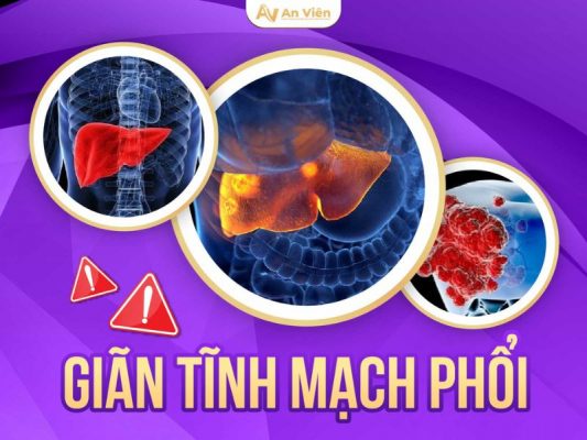 giãn tĩnh mạch phổi