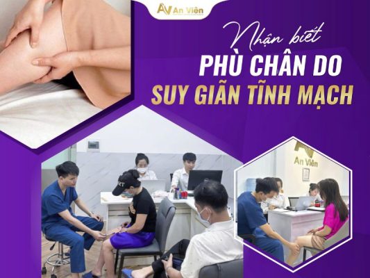 phù chân do suy giãn tĩnh mạch