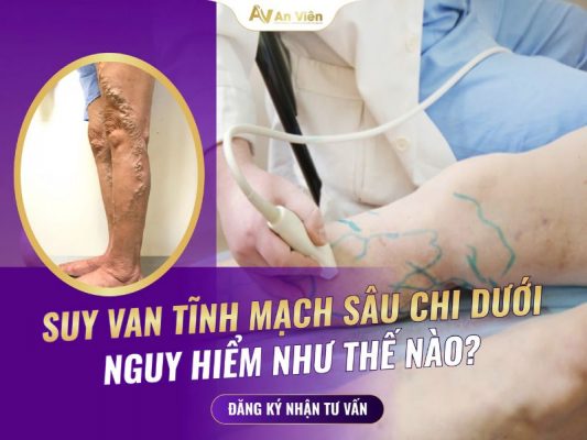 suy van tĩnh mạch sâu chi dưới