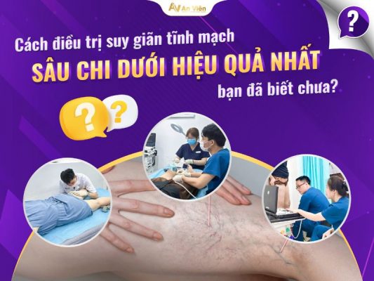 cách điều trị suy giãn tĩnh mạch sâu
