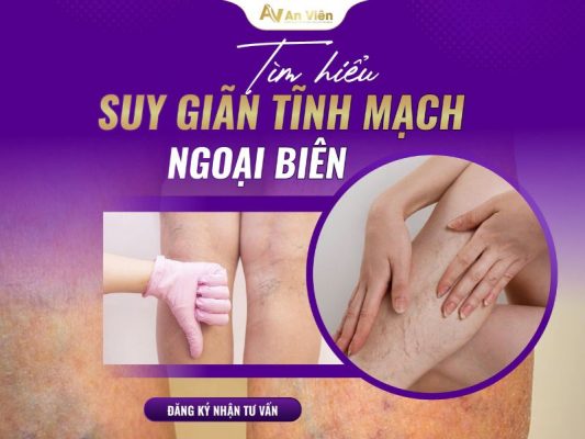 giãn tĩnh mạch ngoại biên