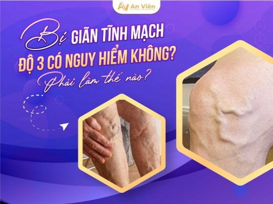giãn tĩnh mạch độ 3