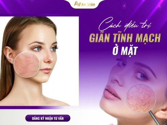 giãn tĩnh mạch ở mặt