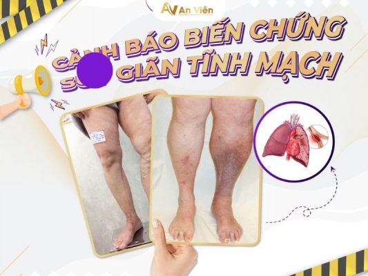 suy giãn tĩnh mạch chân có nguy hiểm không