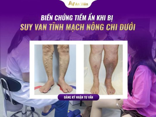 suy van tĩnh mạch nông chi dưới